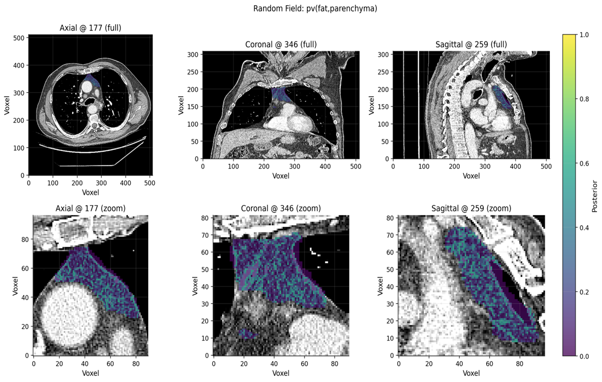 Thoracic CT views showing voxel-level posterior estimates of thymic tissue composition from HostBio Comp-MRF