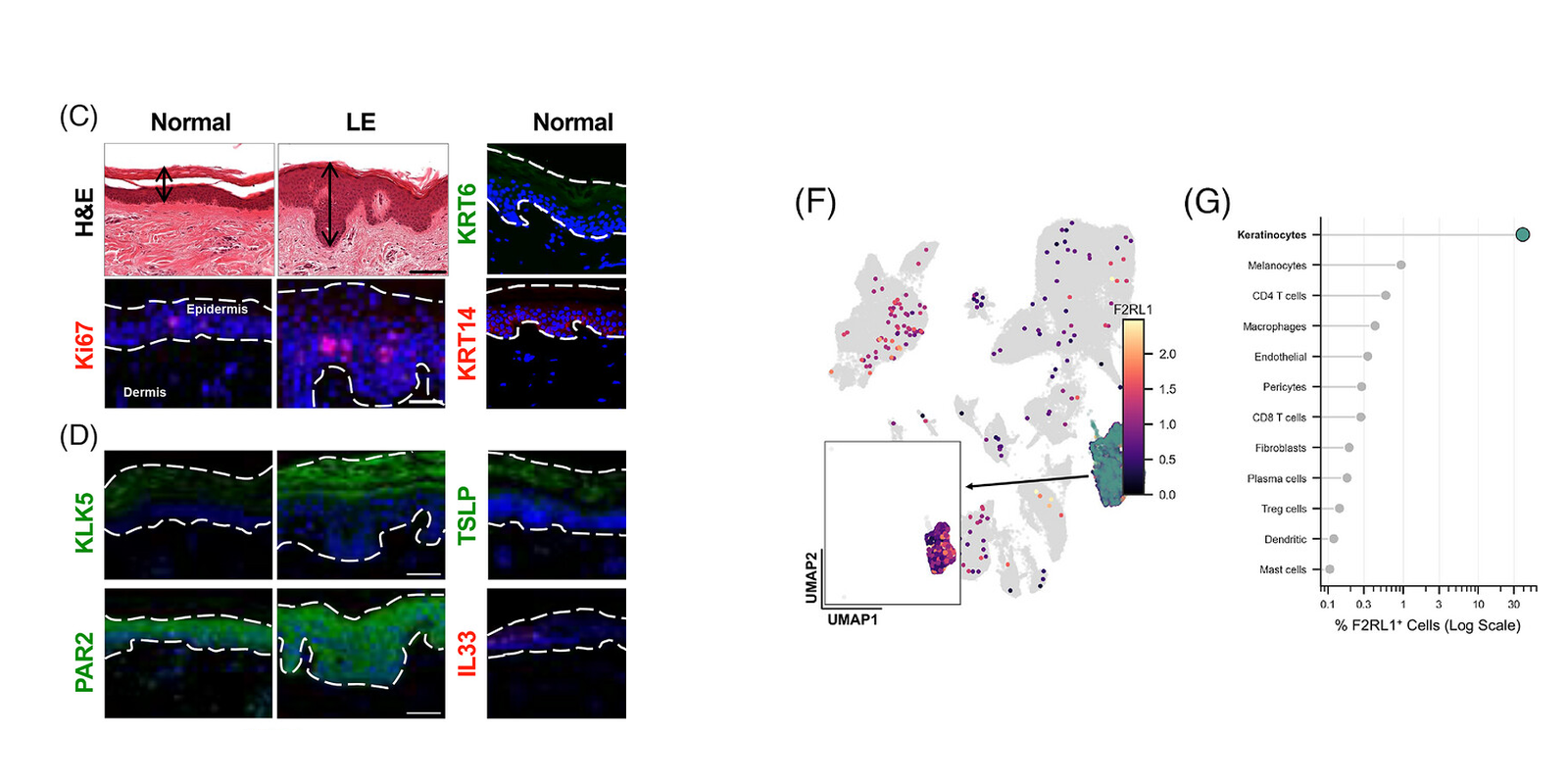 Published secondary lymphedema figure showing epidermal inflammatory remodeling and cell-specific PAR2 biology