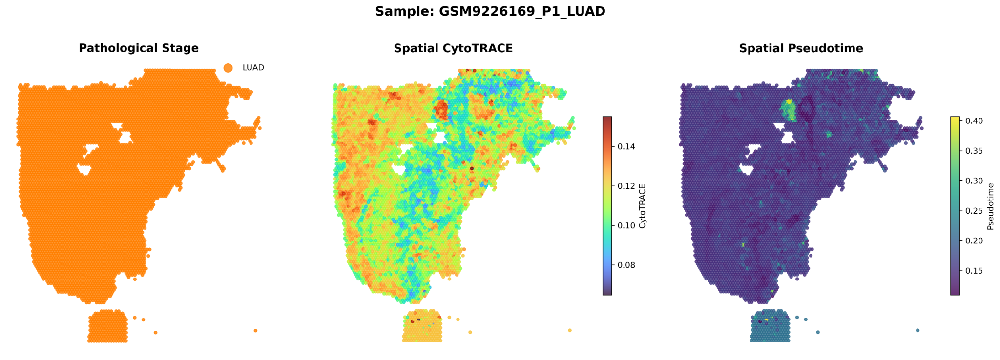 Three spatial transcriptomics panels showing pathological stage, spatial CytoTRACE, and spatial pseudotime for a lung adenocarcinoma sample.